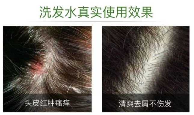 和螨虫说拜拜!持续断货的澳洲茶树洗护系列全新升级!抢先体验(图27)