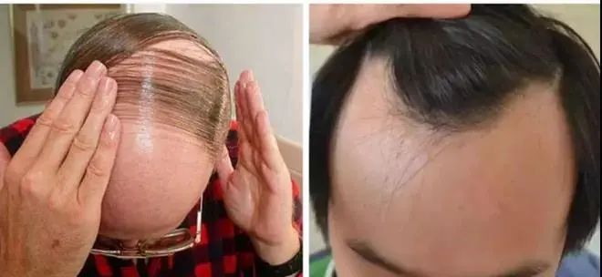 亚麻籽究竟有多神奇?用它,头发蓬松不出油,关键是拯救秃头!(图2)