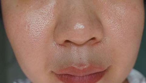 螨虫一除,再回婴儿肌,痘痘不是顽疾!(图7)