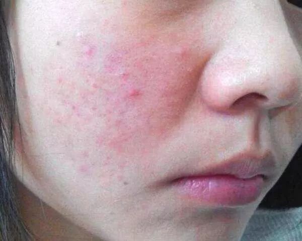 螨虫一除,再回婴儿肌,痘痘不是顽疾!(图11)