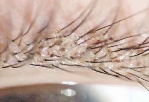 螨虫一除,再回婴儿肌,痘痘不是顽疾!(图9)