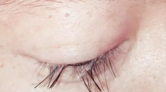 螨虫一除,再回婴儿肌,痘痘不是顽疾!(图10)