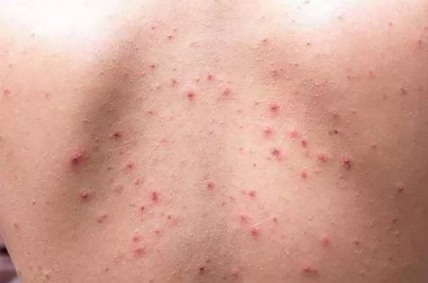 螨虫一除,再回婴儿肌,痘痘不是顽疾!(图12)