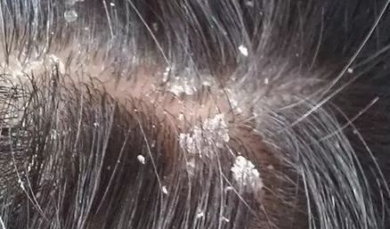 澳洲茶树精油洗发水,除螨、去油、味道芳香(图3) 图片