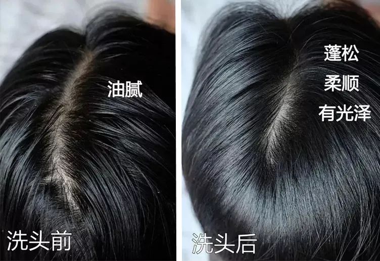 “油头克星”澳洲茶树精油——控油、除螨、去屑一瓶全搞定!(图3) 图片