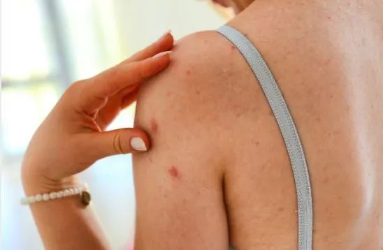 澳洲茶树精油沐浴露除螨祛痘,守候肌肤健康(图11) 图片